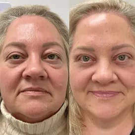 2X1/  Parches de Microagujas + Ácido hialurónico para ojeras, bolsas y arrugas