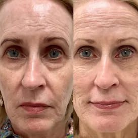 2X1/  Parches de Microagujas + Ácido hialurónico para ojeras, bolsas y arrugas