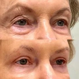 2X1/  Parches de Microagujas + Ácido hialurónico para ojeras, bolsas y arrugas