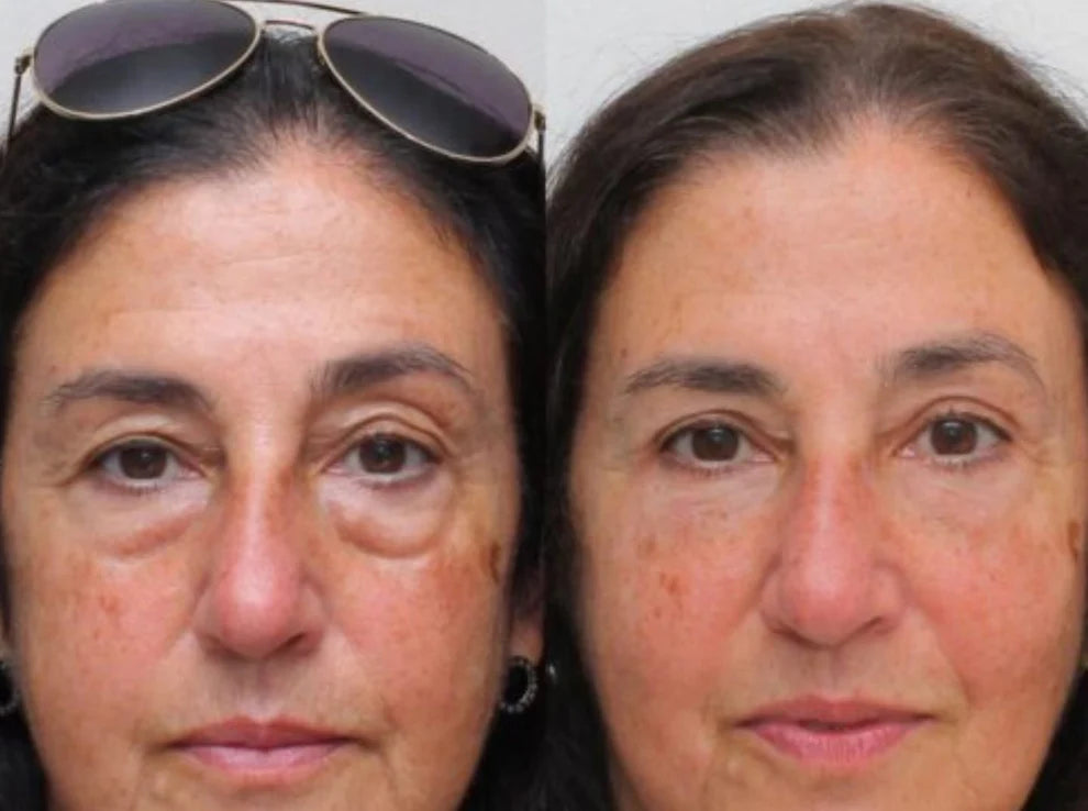 2X1/  Parches de Microagujas + Ácido hialurónico para ojeras, bolsas y arrugas