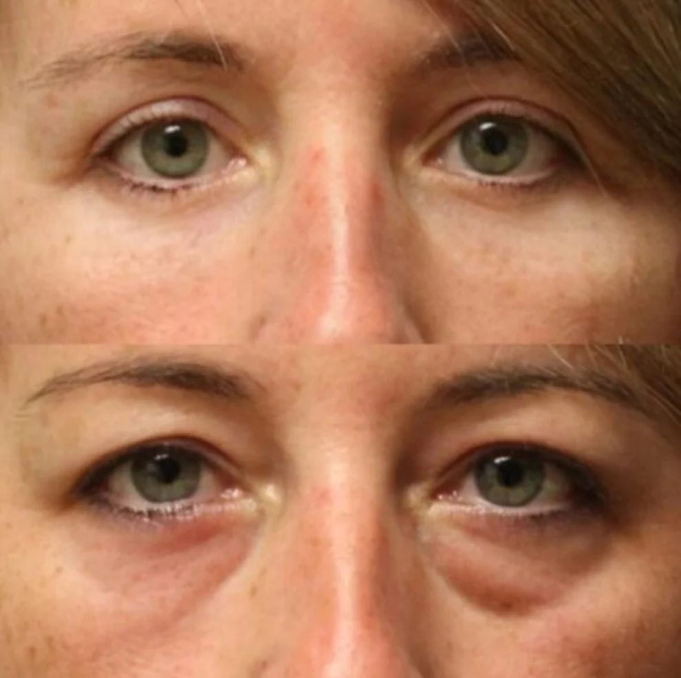 2X1/  Parches de Microagujas + Ácido hialurónico para ojeras, bolsas y arrugas